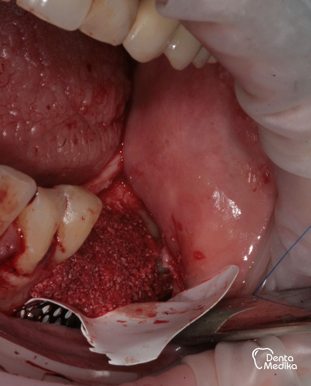 Augmentace kosti Dentamedika Brno 3